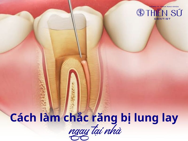 cách làm chắc răng bị lung lay