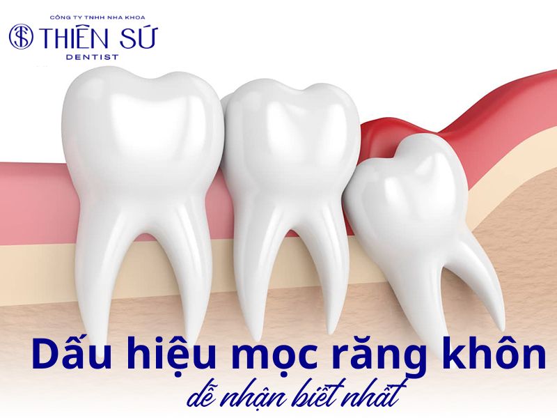 dấu hiệu mọc răng khôn