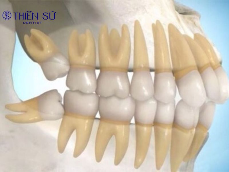 Mọc răng khôn đau mấy ngày