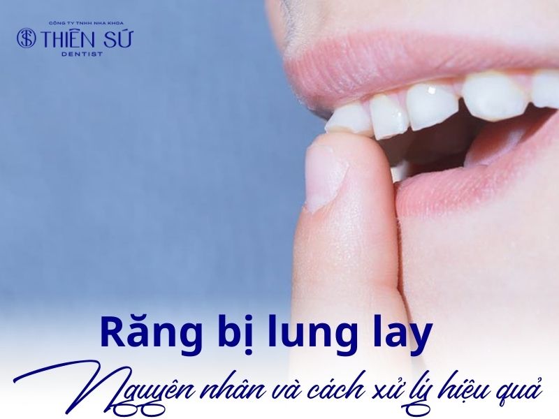 răng bị lung lay