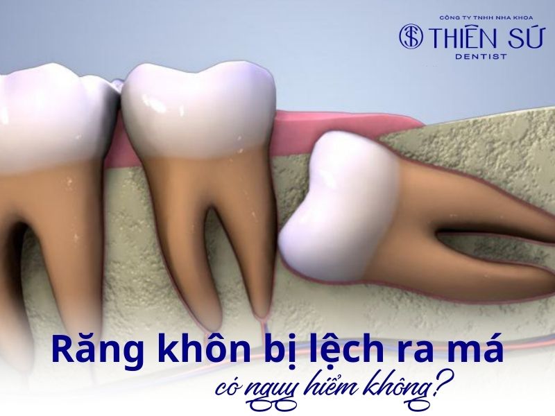 răng khôn bị lệch ra má