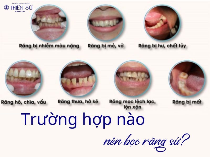 dáng răng sứ đẹp